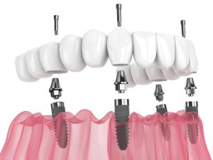 Diagram of how All-on-X dental implants works